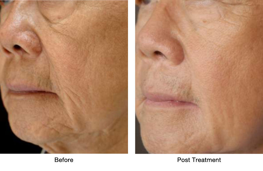 Immediate Results Skin Tightening Auckland
