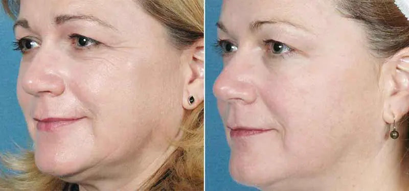 Elos Sublime Skin Treatment