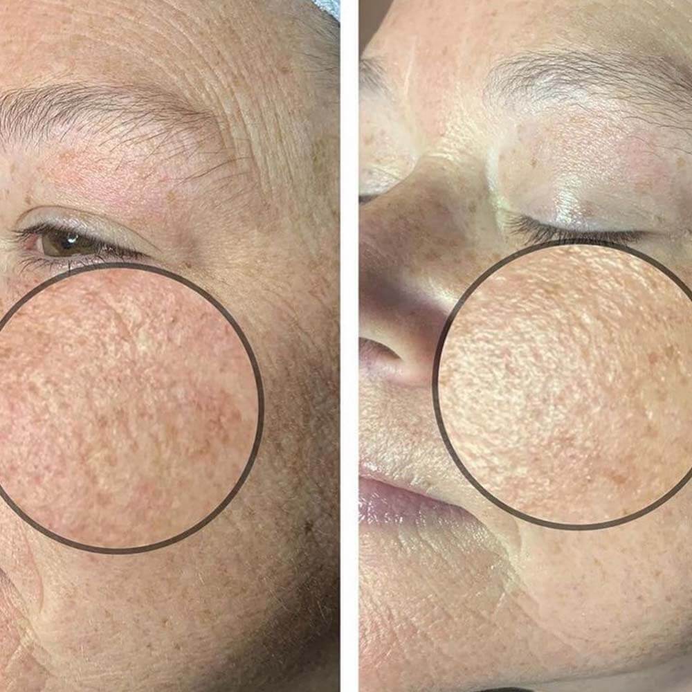 Diamond Microdermabrasion Facial