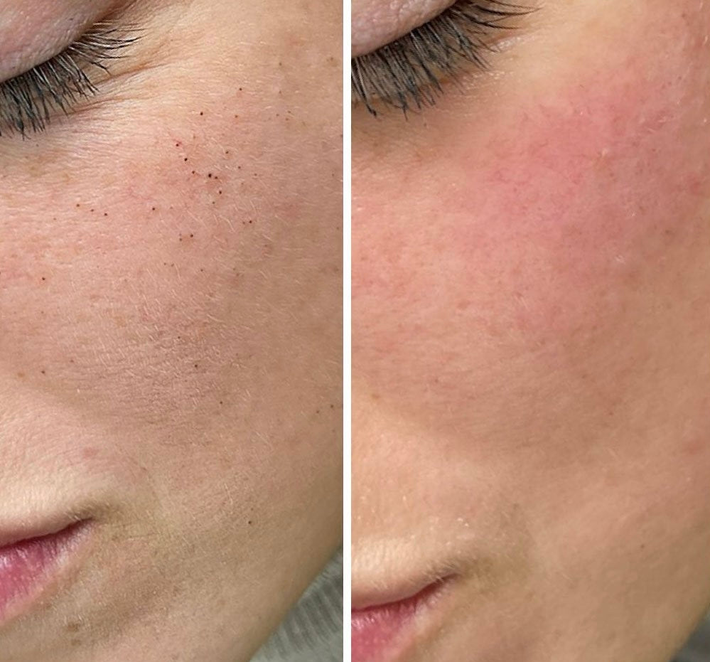 Microdermabrasion Treatment