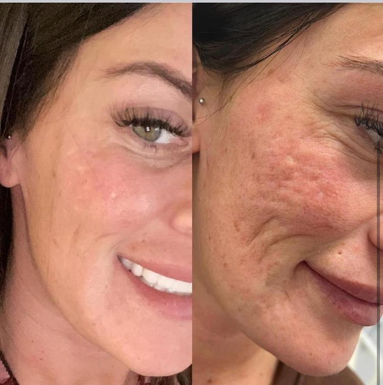 Elos Sublative Rejuvenation Treatment