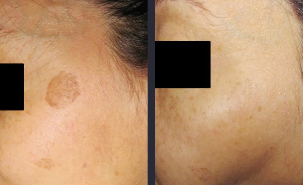 Elos Sublative Resurfacing | The Cosmetic Clinic NZ