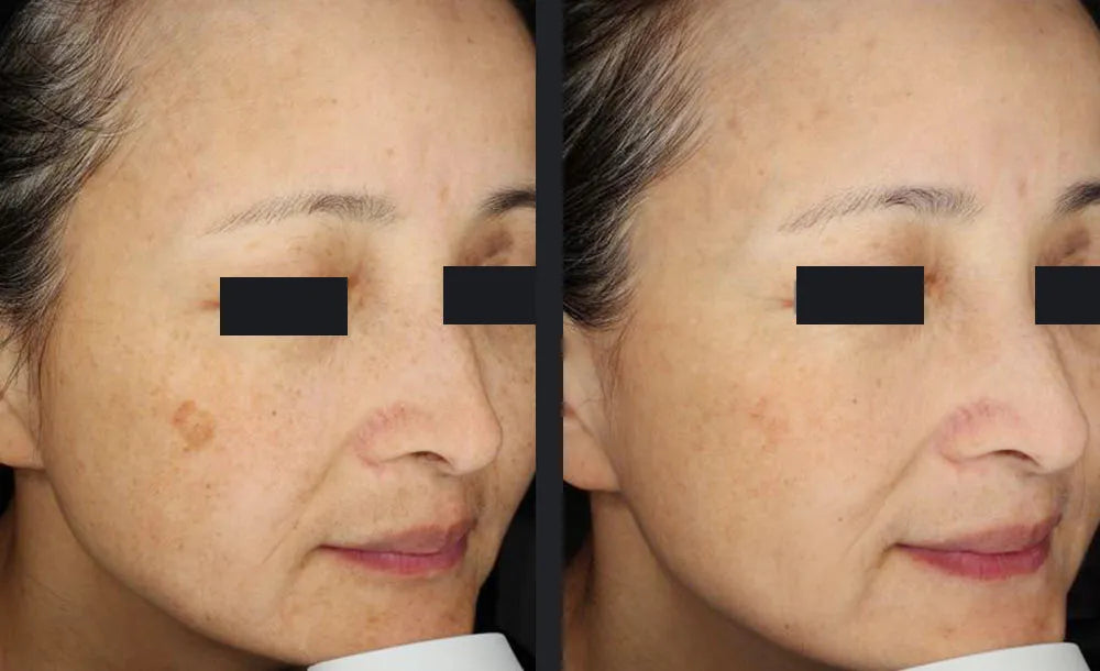 Laser Pigmentation Removal Auckland