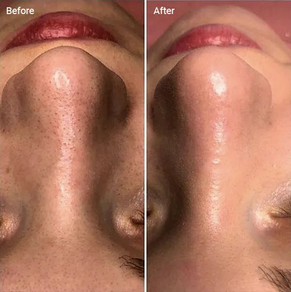Microdermabrasion Treatment Auckland