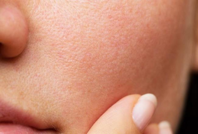 Understanding Rosacea: More Than Just a Red Face"