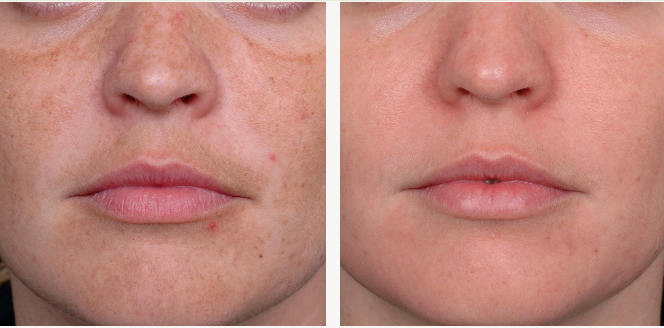 Zapping Away the Spots: Healing Sun Damage and Pigmentation with Cutting-Edge Technology