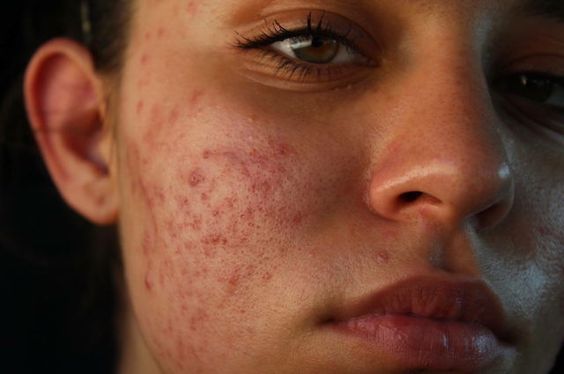 The Acne Chronicles with Jody: Unveiling the Genesis of Clear Skin