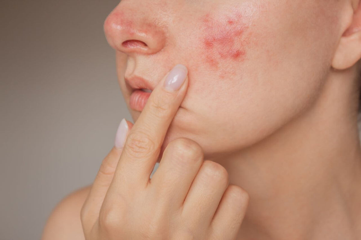 Elos Ac: A Breakthrough Acne Treatment for Clearer, Healthier Skin