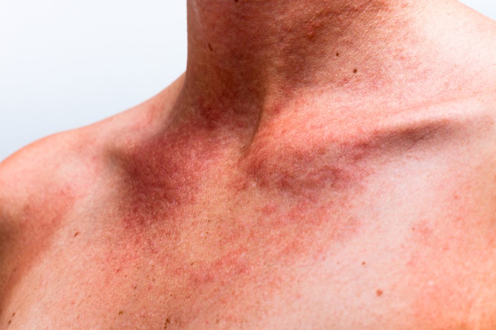 Shining a New Light on Poikiloderma: The Promise of IPL and Cutera Genesis Laser Treatments