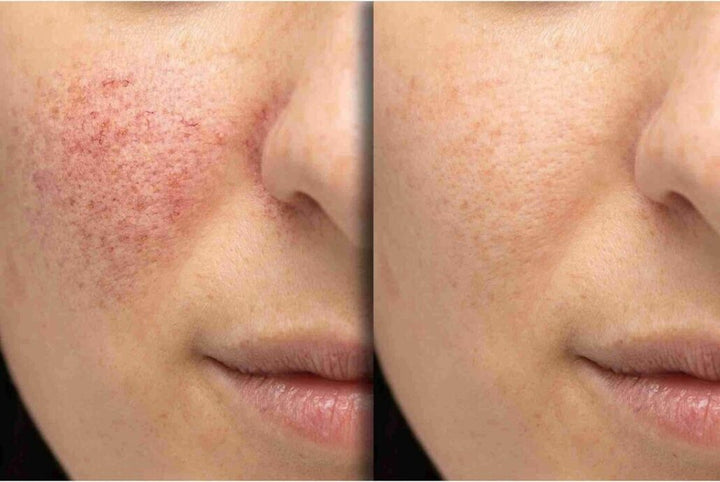 Understanding Rosacea and How the Cutera Genesis Laser Can Help