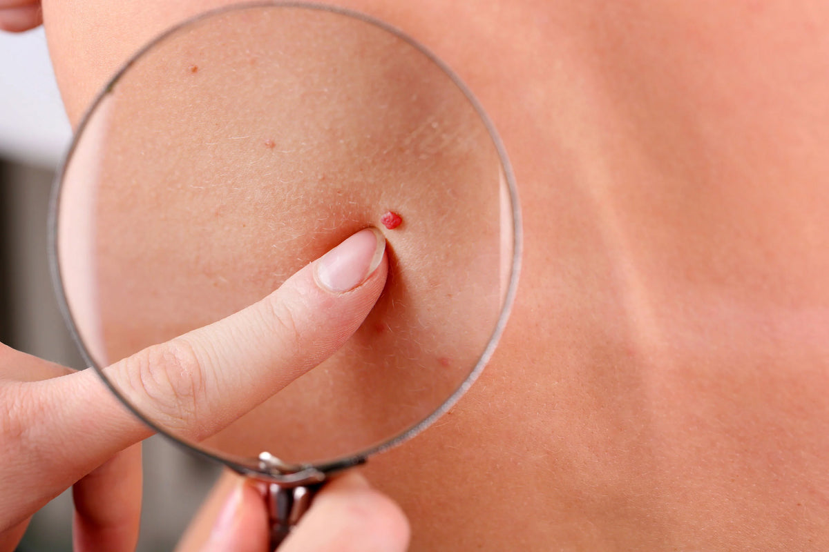 Angiomas | Vascular Skin Treatments