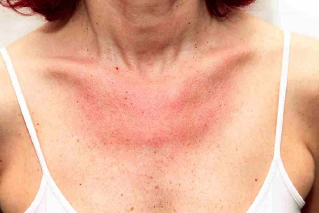 Poikiloderma | LimeLight Skin Treatment