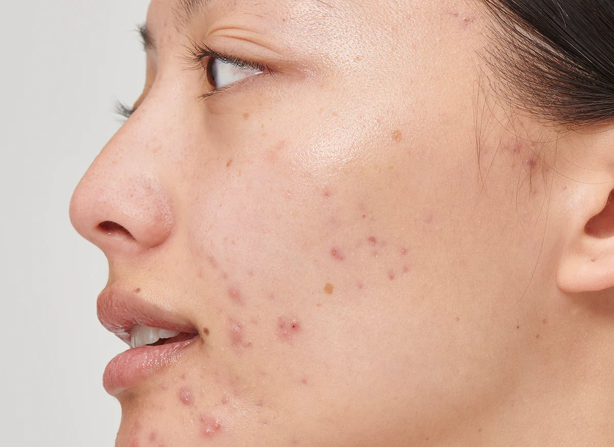 Acne | Skin Laser Treatment Clinic
