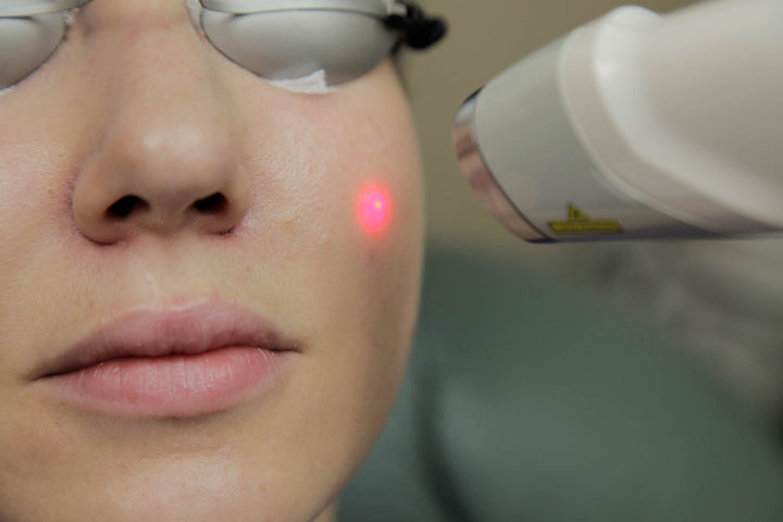 Laser Genesis | Skin Treatment Auckland
