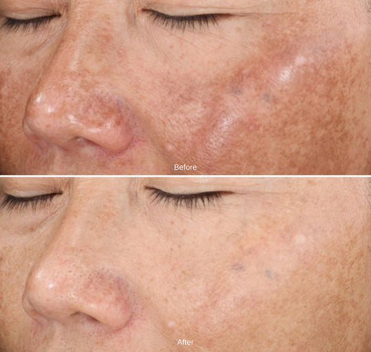 Timeless RX Peel | Chemical Peel