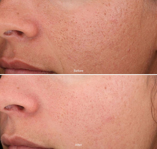 Chemical Peel Before And After