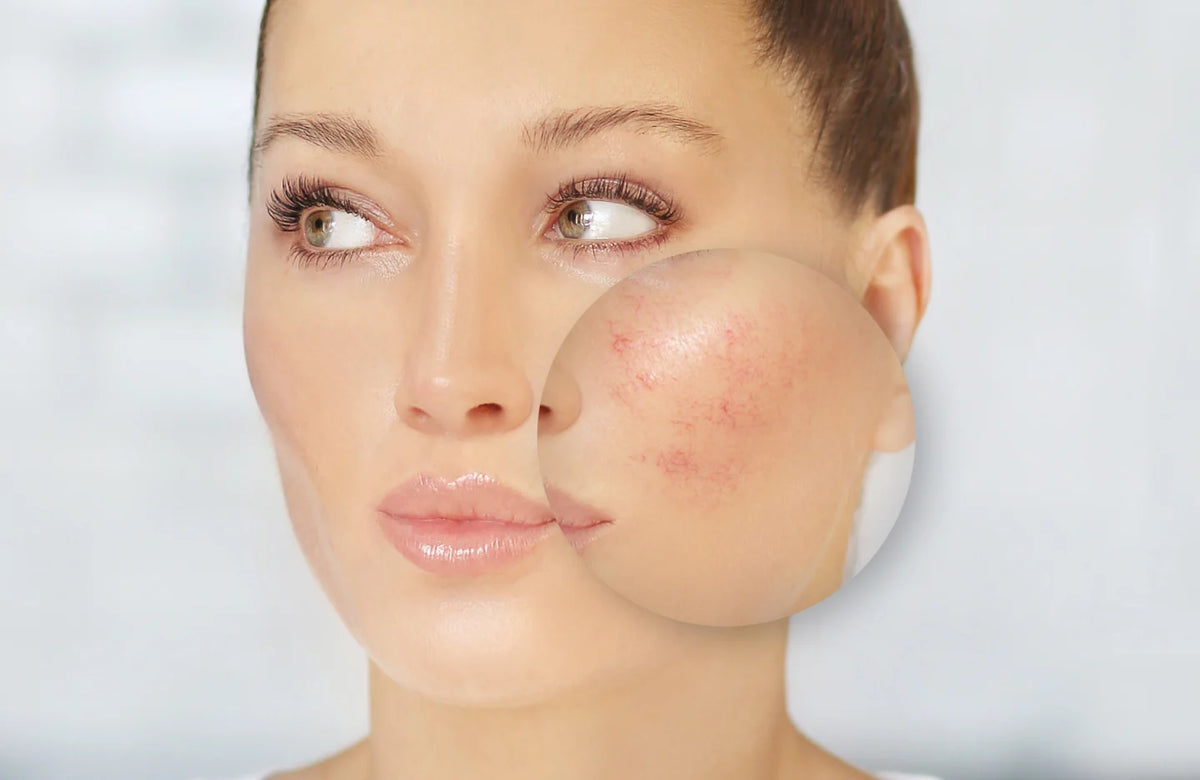 Facial Veins | Skin Treatment Clinic