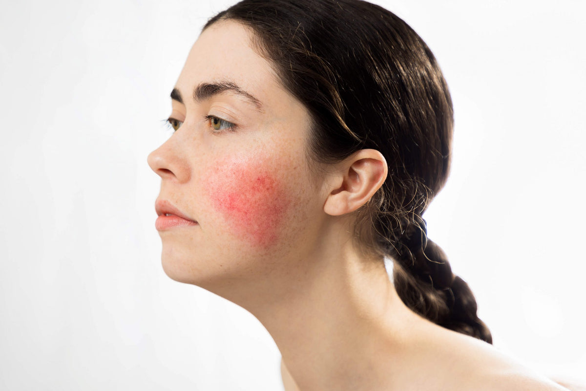 Rosacea | Skin Care Clinic Auckland