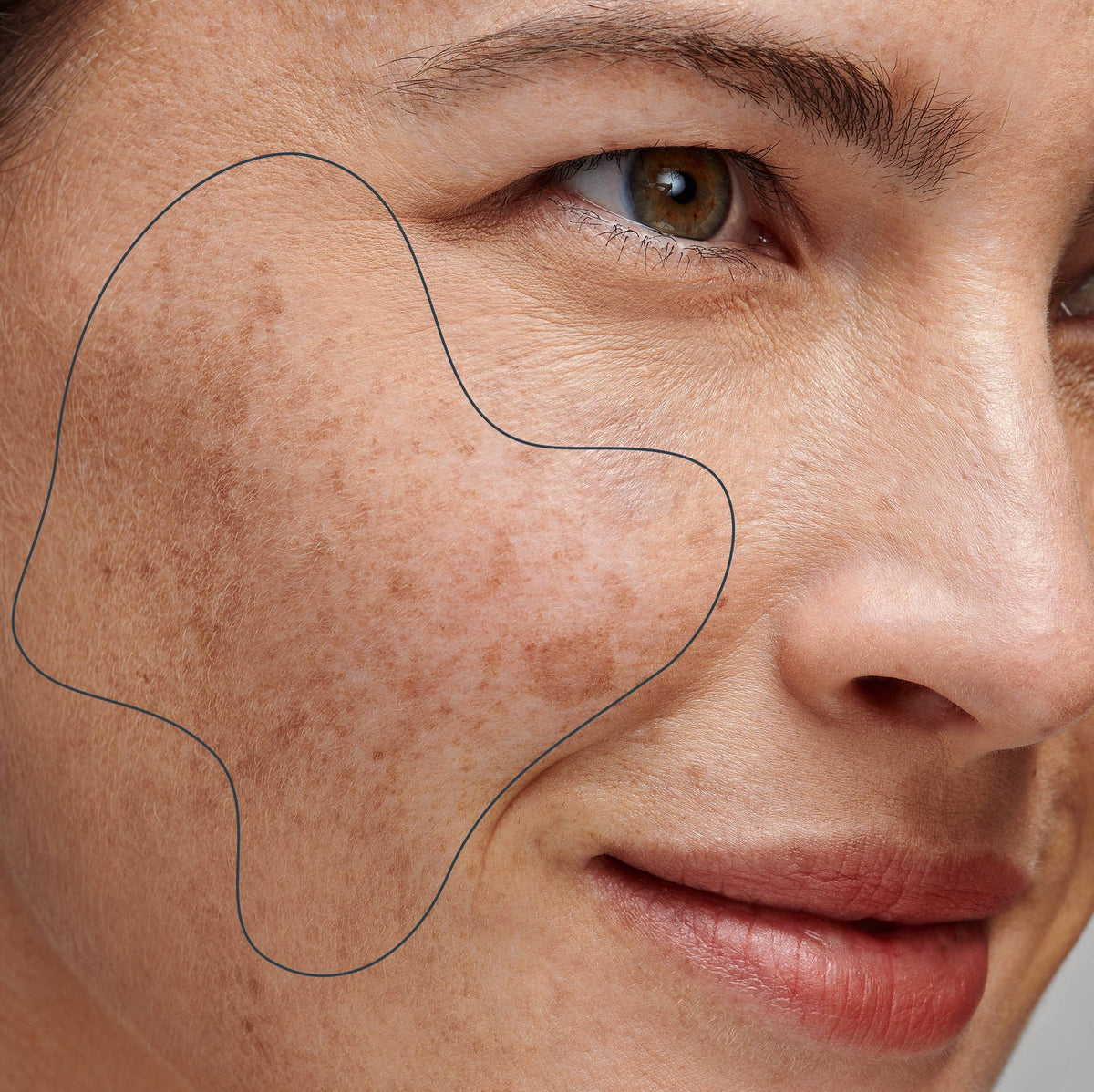Pigmentation | Laser Skin Rejuvenation Auckland