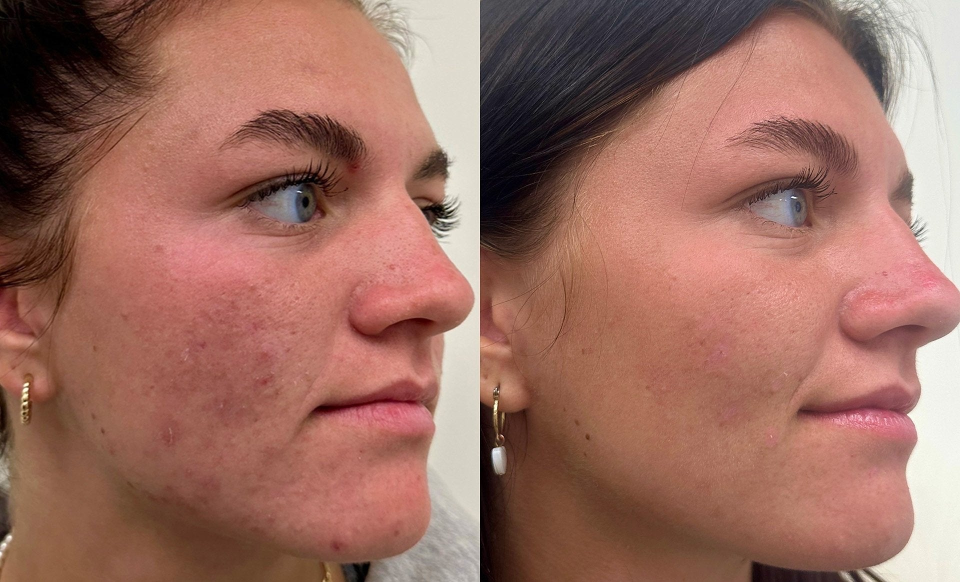 Dermapen before and after showing the same client