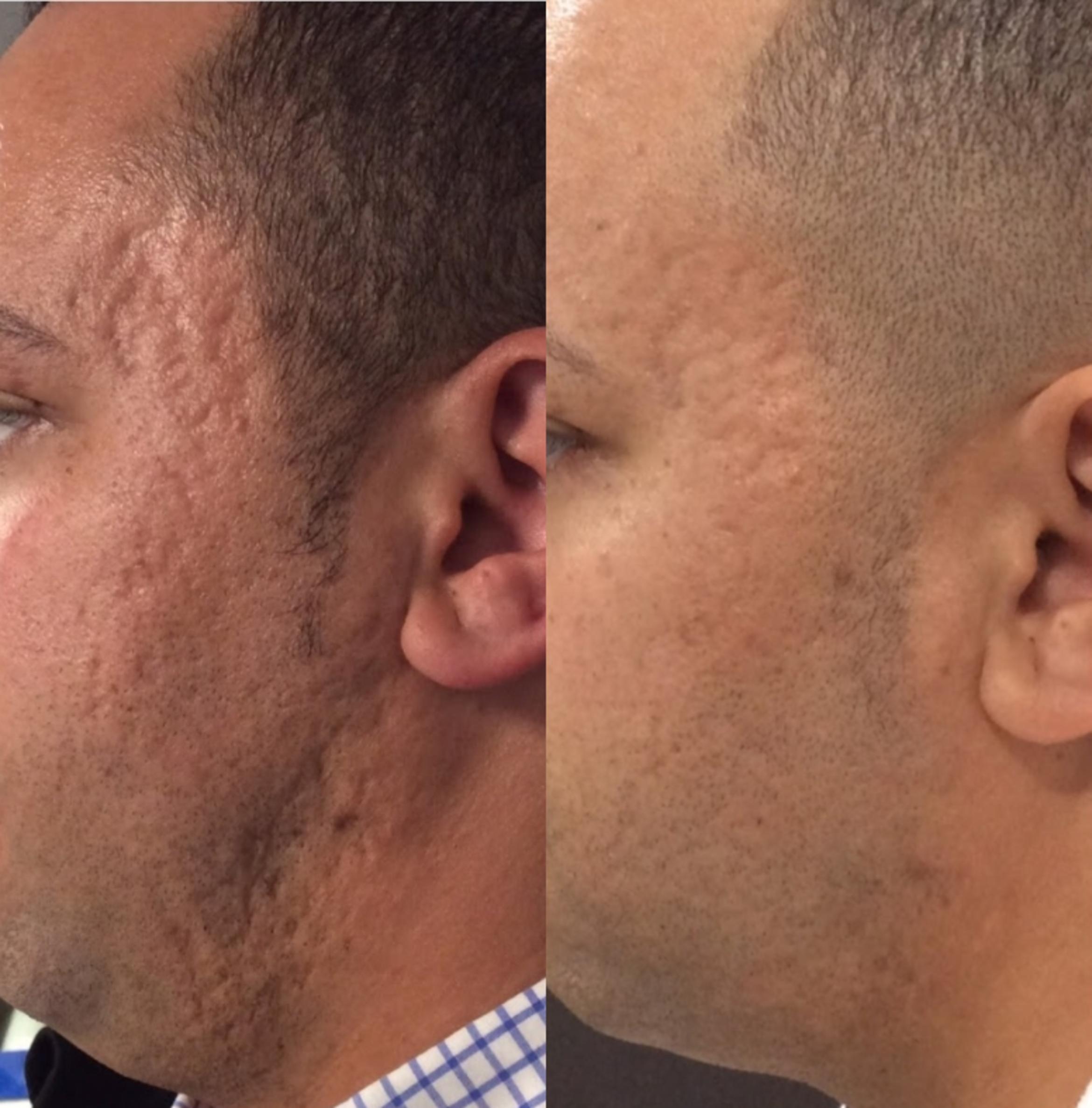 Dermapen before and after close-up skin-texture example