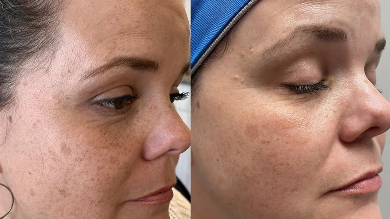 Dermapen before and after skin-texture example