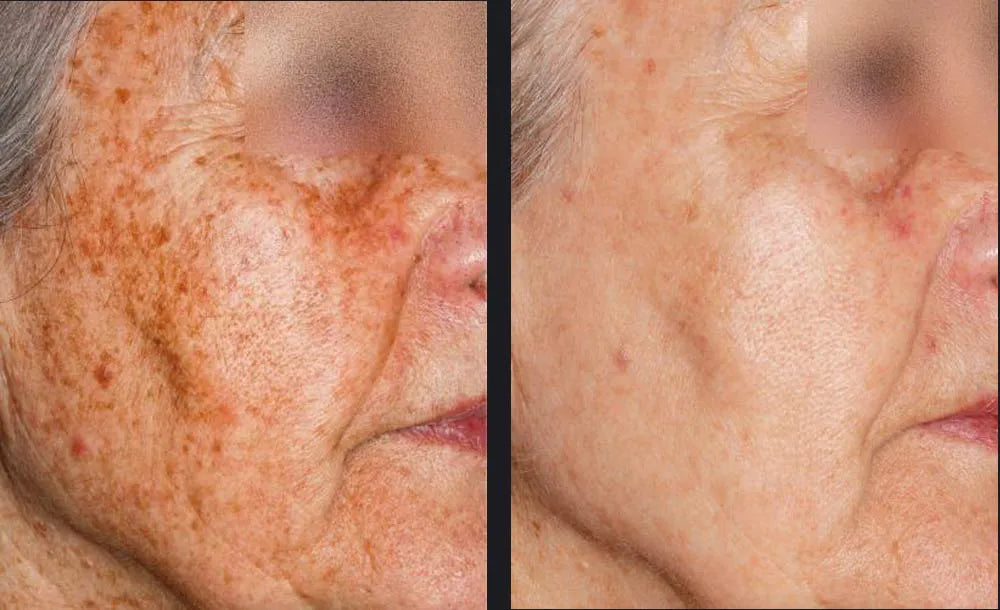 Pigmentation before and after example from the current About Skin page