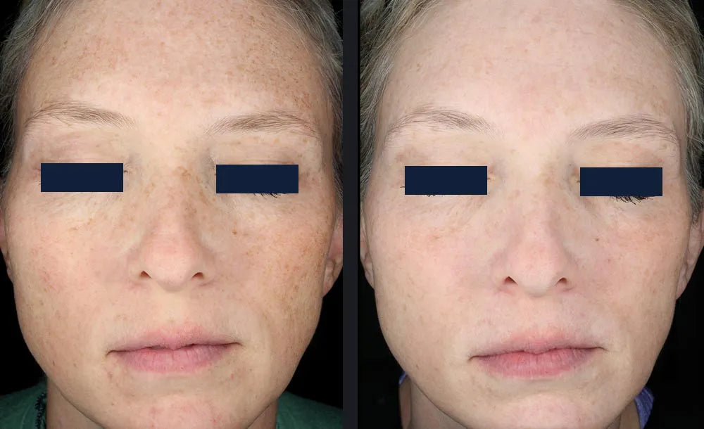 Skin rejuvenation before and after example from the current About Skin page