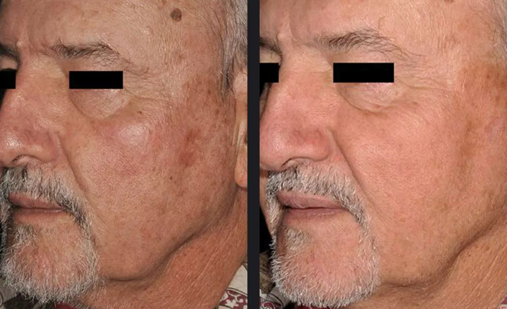 Skin rejuvenation before and after example from the current About Skin page