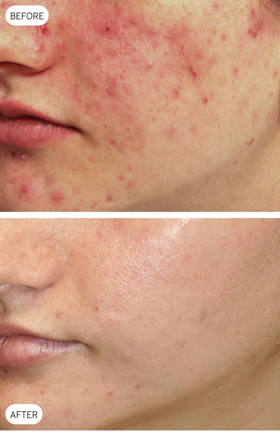 Laser Genesis before and after skin-treatment example