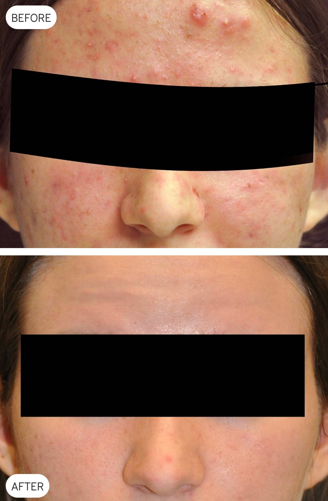 Laser Genesis before and after skin-treatment example