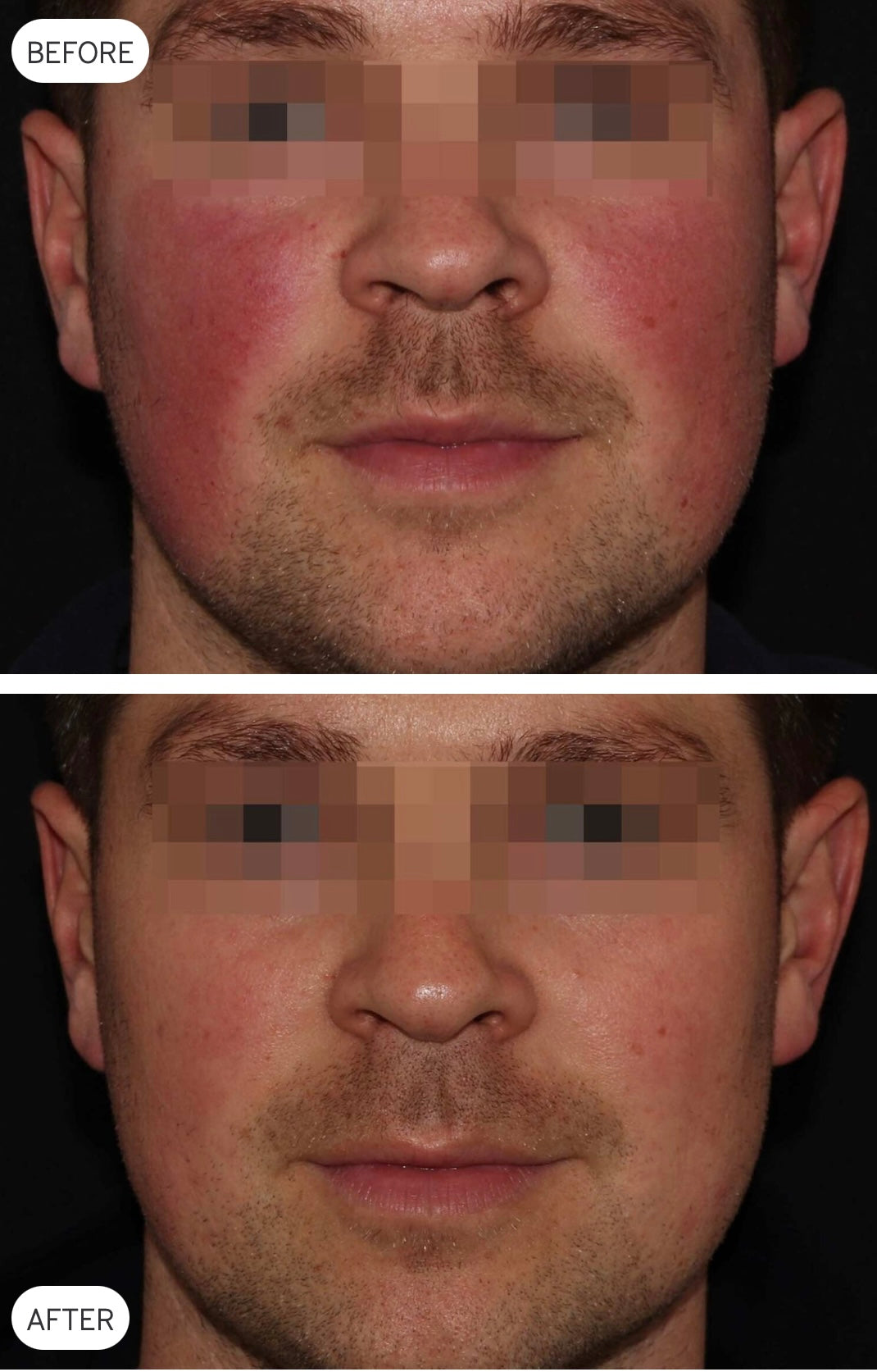 Laser Genesis before and after skin-treatment example