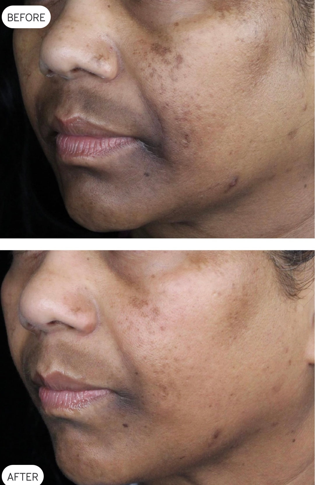 LimeLight before and after skin-treatment example