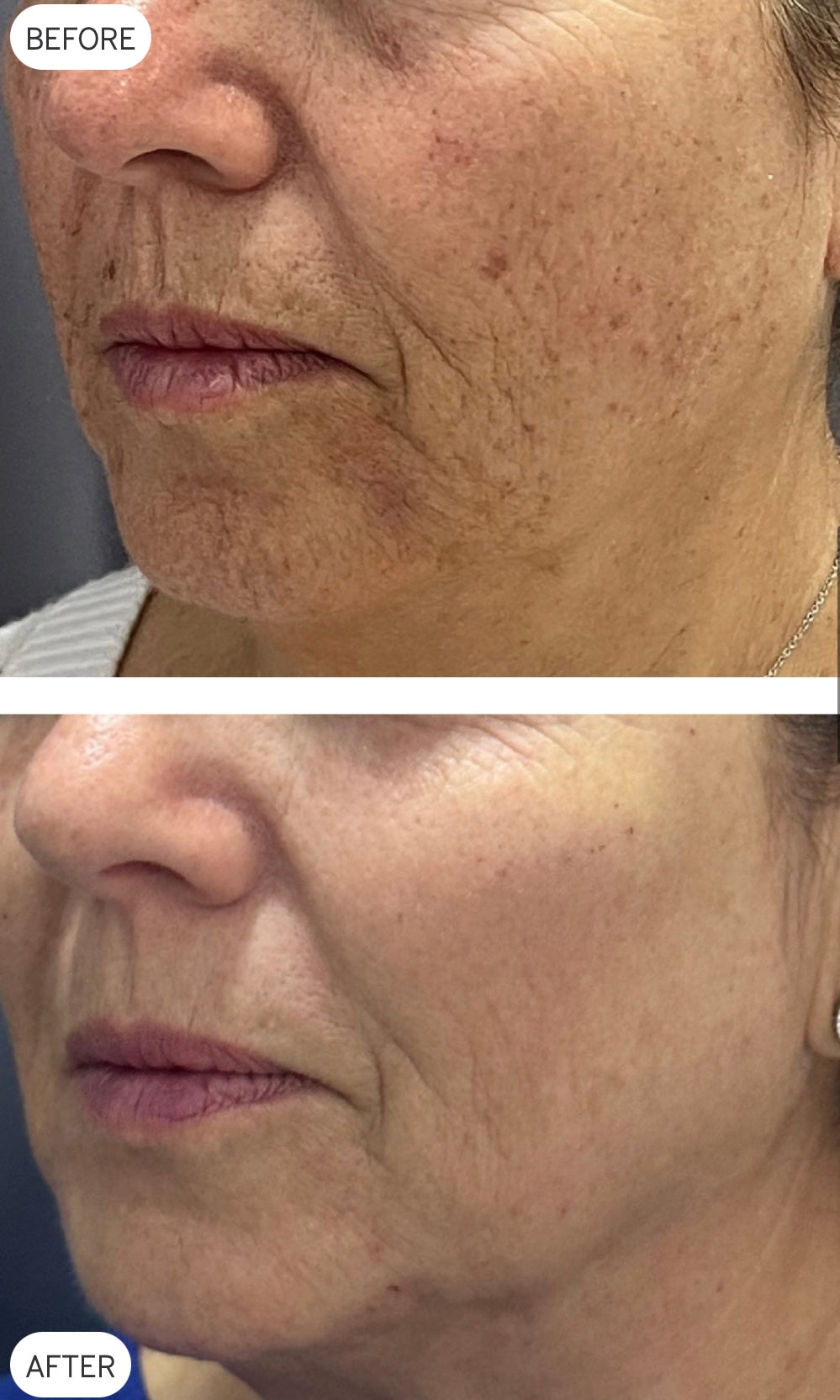 LimeLight before and after skin-treatment example