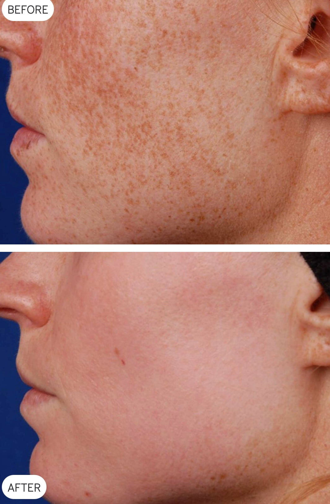 LimeLight before and after skin-treatment example
