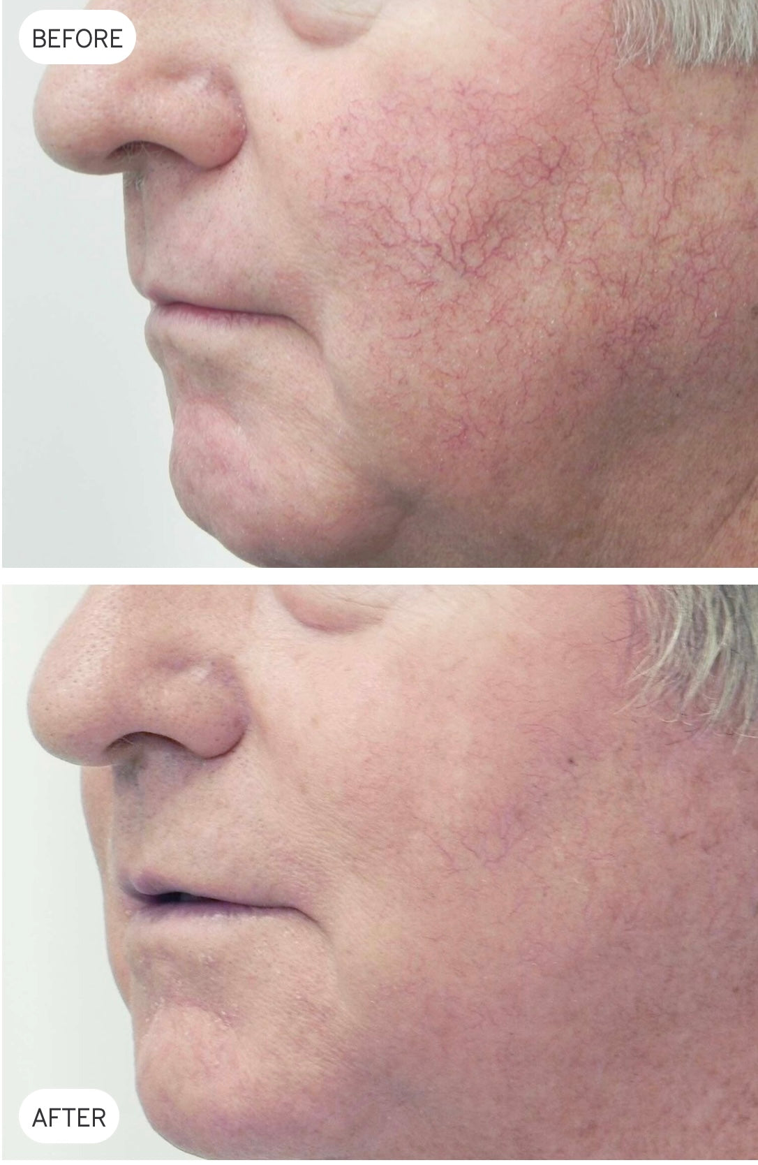 Cutera XEO YAG vascular-treatment before-and-after example