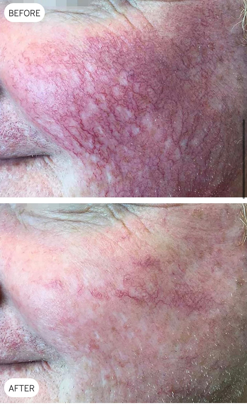 Cutera XEO YAG vascular-treatment before-and-after example