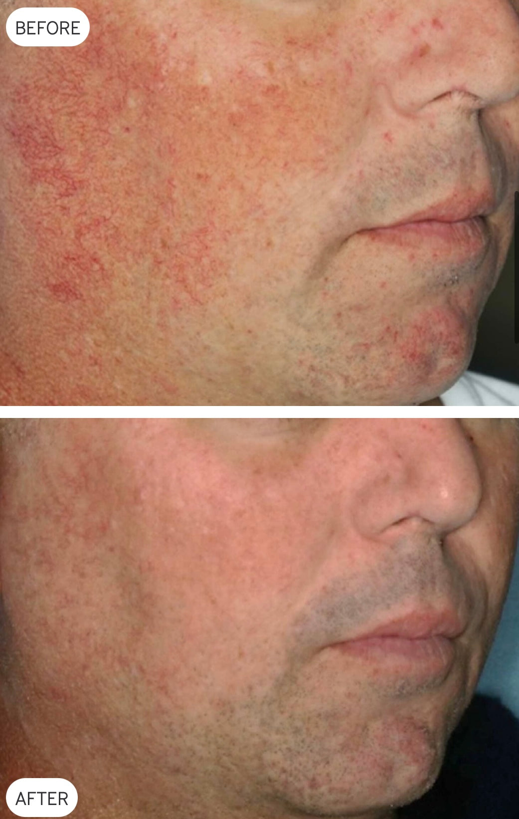 Cutera XEO YAG vascular-treatment before-and-after example
